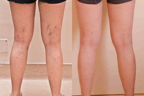💖koop meer bespaar meer✨Wis lichaamsimperfecties in een seconde
